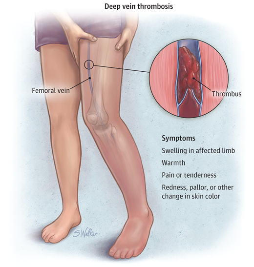 Deep vein thrombosis 1