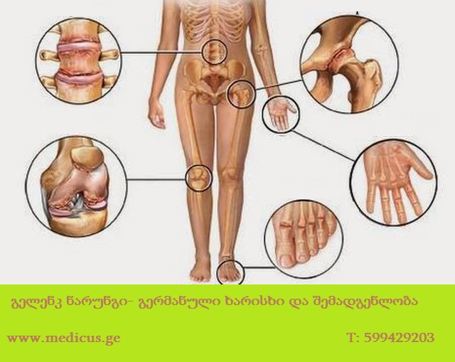 dunedin osteoarthritis