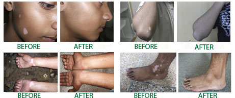 vitiligo