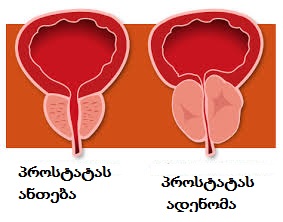 prostata